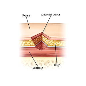 Изображение кожи, мышц, жира и раны в поперечном разрезе.