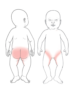 Baby with candida rash on buttocks, in crease of legs and trunk, and on inside of thighs.