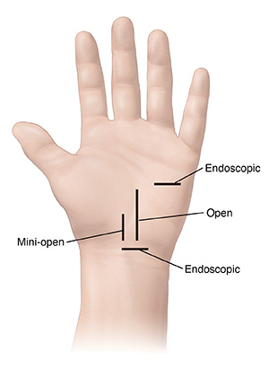 Carpal Tunnel Release Surgery