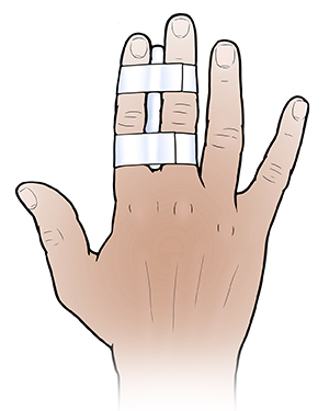 Back of hand showing two fingers taped together.