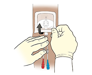 Closeup of arm with midline catheter. One gloved hand holding catheter while other gloved hand pulls up corner of dressing.