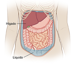 Contorno del abdomen de una mujer donde puede verse líquido acumulándose en la cavidad abdominal.